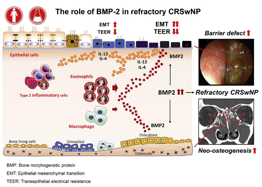 Bone morphogenetic protein-2 as a novel biomarker for refractory chronic rhinosinusitis with nasal polyps (Kim, J. Y., 2021)