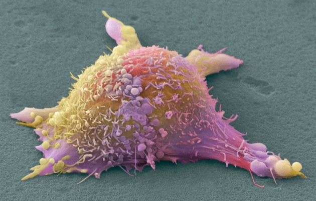 Researchers Push for Personalized Tumor Vaccines