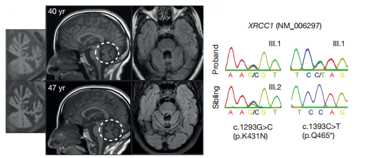 XRCC1 mutations are associated with cerebellar ataxia, ocular motor apraxia, and axonal neuropathy