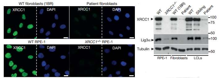 Mutations in patient-derived XRCC1 reduce XRCC1 levels