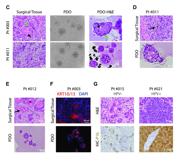 Morphological and pathological recapitulation of patient-derived organoids with matched tumor sources