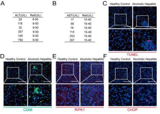 Fig 8. Hepatocyte apoptosis, inflammation, and ER stress are markedly increased in human alcohol-associated liver disease.