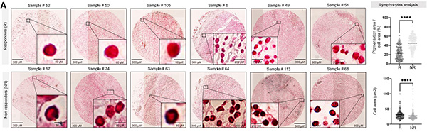 The presence of melanosomes correlates with poor prognosis
