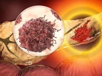 New Hope Emerges in Pancreatic Cancer Treatment