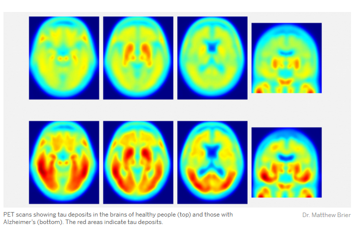 tau protein in alzheimer symptoms