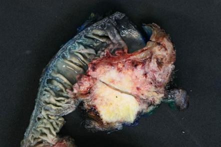 pancreatic ductal adenocarcinoma