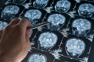 MRI Alzheimers Research