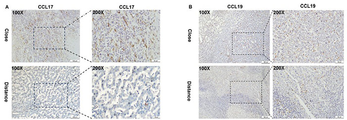Localization of CCL17 and CCL19 in the liver of AE patients. (A) CCL17 IHC staining.
(B) CCL19 IHC staining