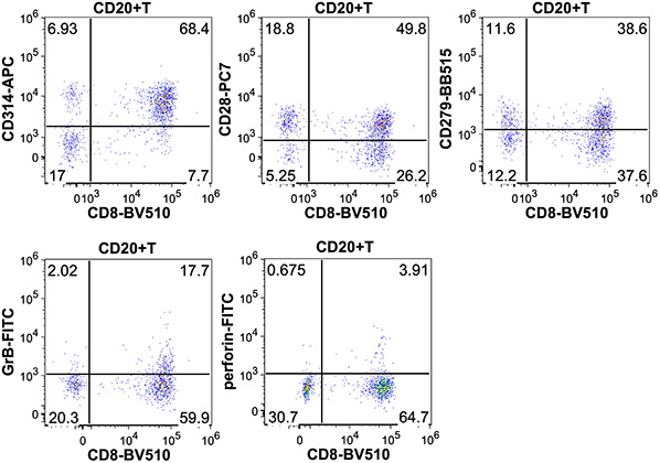 Multiparameter flow cytometry and transcriptional analysis of CD20+ T cells in bone marrow of multiple myeloma and MGUS patients
