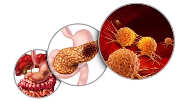 Overview of Pancreatic Cancer Stem Cell Markers