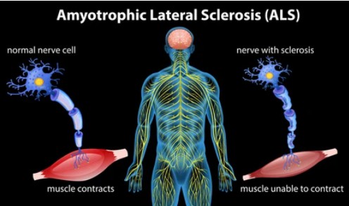 Amyotrophic lateral sclerosis illustration - Creative BioMart