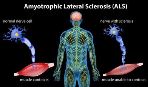 Amyotrophic lateral sclerosis illustration - Creative BioMart
