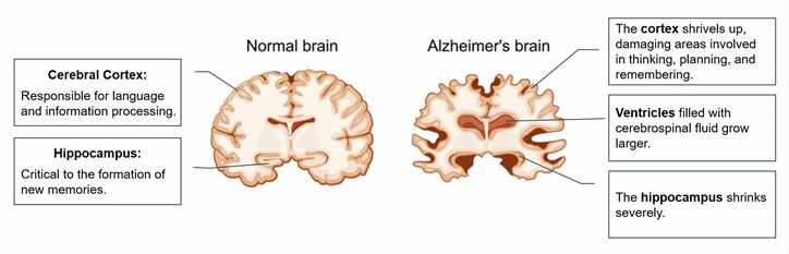 Alzheimer‘s Disease - Creative BioMart