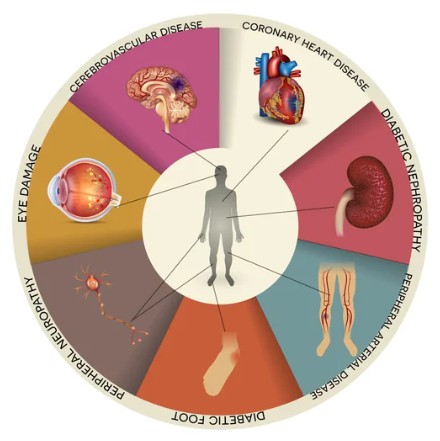 Diabetic peripheral neuropathy - Creative BioMart 