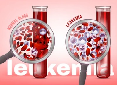 Leukemia - Creative BioMart 