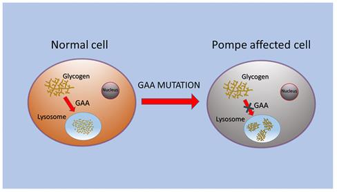Figure 1. Schematic representation of GAA alteration that caused glycogen storage in lysosomes of PD cells. (Taverna S, et al., 2020)