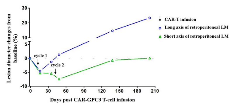 Fig4. Dynamic changes in the retroperitoneal lymphatic metastasis after CAR-GPC3 T-cell infusions.