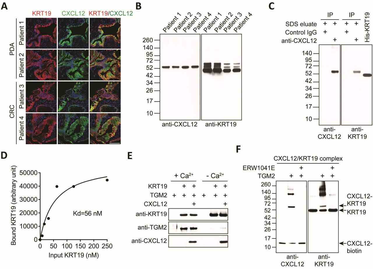 ( A ) Sections of freshly resected human PDA and CRC were stained with fluorochrome-conjugated antibodies to KRT19 and CXCL12. Scale bar, 100 μm. ( B ) SDS-eluates of samples of the resected PDA and CRC were 5 subjected to SDS-PAGE and immunoblotting with antibodies to CXCL12 and KRT19. ( C ) The proteins that were immunoprecipitated by control IgG or anti-CXCL12 IgG from the pooled SDS-eluates of the four tumors were subjected to SDS-PAGE and immunoblotting with anti-CXCL12 and anti-KRT19 antibodies. ( D ) Streptavidin-beads bearing CXCL12-biotin were incubated with increasing concentrations of KRT19. Bound KRT19 was detected by SDS-PAGE 10 and immunoblotting with anti-KRT19 antibody. The apparent affinity with which CXCL12 and KRT19 interacted was calculated. ( E ) Anti-KRT19 antibody/protein G beads were incubated at 4°C with combinations of KRT19, CXCL12 and TGM2, in the presence or absence of Ca 2+ . The bound proteins were detected by SDS-PAGE and immunoblotting with the indicated antibodies. ( F ) Streptavidin beads bearing preformed complexes of biotinylated CXCL12 and KRT19 were 15 incubated at 20°C for 15 min with TGM2 in the presence or absence of the TGM2 inhibitor, ERW1041E. The proteins were eluted from the beads and detected by SDS-PAGE and immunoblotting with antibodies to CXCL12 and KRT19.