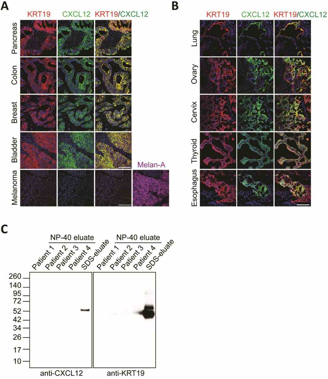( A - B ) Sections of FFPE human carcinomas and melanoma (A) and frozen human carcinomas (B) were stained with fluorescent antibodies to KRT19 and CXCL12. Scale bars, 100 μm. ( C ) The NP-40 eluates of the four human tumors were subjected to SDS-PAGE and immunoblotting with anti-CXCL12 or anti-KRT19 antibodies. The SDS eluate of patient 2 was applied as a positive control.