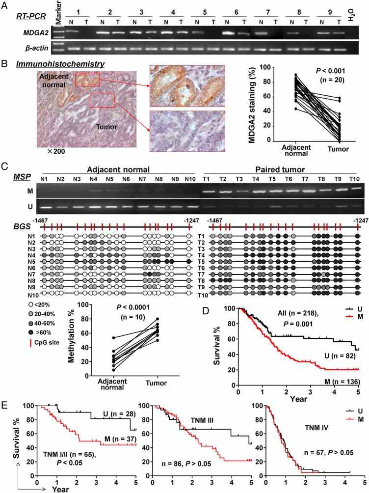 Epigenetic inactivation of MDGA2 in primary gastric cancers. (A) Transcriptional downregulation of MDGA2 in gastric tumours compared with adjacent normal tissues was shown by reverse transcription PCR (RT-PCR). (B) Protein levels of MDGA2 were quantitated as the percentage of cells with positive staining by immunohistochemistry in 20 pairs of gastric tumour and adjacent non-tumour samples. (C) Methylation-specific PCR (MSP) showed high methylation of MDGA2 promoter in 10 gastric tumours and low methylation in their adjacent non-tumour tissues, which was confirmed by bisulfite genomic sequencing (BGS). M, methylated; U, unmethylated. (D) Kaplan–Meier curves showed that MDGA2 methylation is significantly associated with shortened survival in overall patients with gastric cancer and (E) in patients at an early stage but not patients at late stages (log rank test).