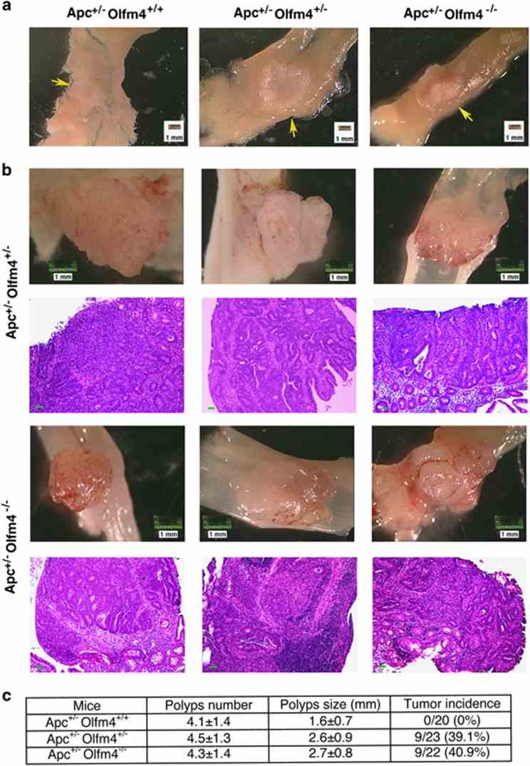 Olfm4 deletion induces large polyps in the small intestine and adenocarcinoma formation in the distal colon of Apc +/? mice. ( a ) Polyp formation (arrow) in the small intestine of Apc Min/+ , Apc +/? Olfm4 +/? and Apc +/? Olfm4 ?/? ( Apc Olfm4 double-mutant) mice. ( b ) Adenocarcinoma formation in the distal colon of Apc +/? Olfm4 +/? and Apc Olfm4 double-mutant mice. Three representative tumors in mice of each genotype are presented. Hematoxylin and eosin (HE) histology staining is shown below each corresponding tumor. Scale bar, 50 μm. ( c ) Mean (±s.d.) small intestinal polyp number and size, and colon-tumor incidence in Apc Min/+ ( n =20), Apc +/? Olfm4 +/? ( n =23) and Apc Olfm4 double-mutant mice ( n =22) mice.