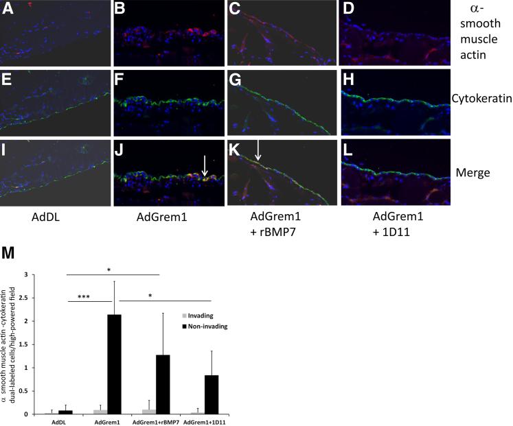 Evidence of EMT in peritoneal tissue. Sections stained for α smooth muscle actin (red, A–D), cytokeratin (green, E–H) and merged (I–L). A, E, and I: There is no evidence of EMT after infection with AdDL. B, F, and J: B6 mice demonstrate evidence of EMT with cells labeled with both α smooth muscle actin and cytokeratin (arrow). C, G, and K: Similar co-expression is seen in animals treated with AdGrem1 and rBMP7 (arrow). D, H, and L: Blockade of TGF-β using 1d11 prevents EMT. Blue – DAPI nuclear stain. M: Dual-labeled cells are quantified as noninvading (within the mesothelial cell layer) and invading (in the submesothelial zone). There is a significant decrease in EMT in AdGrem1-exposed animals treated with 1D11. n = 4 for control (AdDL) animals; n = 6 for treatment groups. Data are expressed as means ± SD (M). ?P < 0.05, ???P < 0.001. Original magnification: ×200 (A–L).