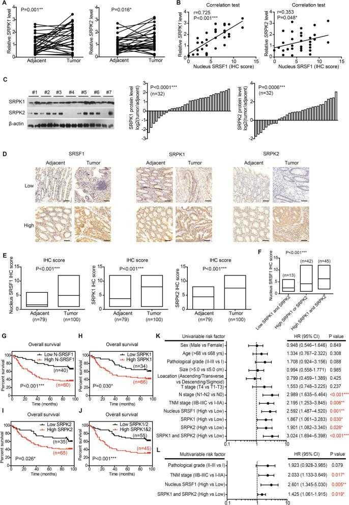 Expression and prognostic role of SRPKs in CAC. a RNA levels of upstream kinases targeting splicing factors in paired clinical specimens were tested by RT-qPCR ( n = 32). P value was based on paired Student’s t-test. b Correlations between nucleus SRSF1 level and upstream kinases were analyzed via Spearman correlation test ( n = 32). The nucleus SRSF1 level was scored by the specific nucleus staining of SRSF1 (ranging 0–12) without considering its cytosol staining. c Protein levels of SRPK1 and SRPK2 in paired clinical specimens were tested by western blotting (left panel). After semi-quantified, we found that 75% cases (24/32) showed increased SRPK1 in tumor tissues (middle panel), and 71.9% cases (23/32) exhibited increased SRPK2 (right panel). d Representative IHC results of SRSF1, SRPK1, and SRPK2 in specimens from validation cohort. Scale bar: 100 μm. e The different protein levels of SRPK1, SPRK2, and nucleus SRSF1 in validation cohort were exhibited by box plots according to IHC data. P value was based on unpaired Student’s t-test. f Patients with both high-SRPK1 and high-SRPK2 levels exhibited the highest nucleus SRSF1 level, while patients with low SRPK1 and low SRPK2 showed the lowest nucleus SRSF1 IHC score. P value was based on One-way ANOVA test. Kaplan-Meier survival curves showed the clinical relevance of nucleus SRSF1 ( g ), SRPK1 ( h ), and SRPK2 ( i ) in validation cohort of CAC patients, respectively. Furthermore, the higher expression of both SRPK1 and SRPK2 showed a more significant role on indicating poorer overall survival ( j ). Forest plots summarized the significant prognostic factors by univariate ( k ) and multivariate ( l ) analyses, the corresponding data were supplemented in Table S and Table S5. P value was calculated by log-rank test or Cox-regression test