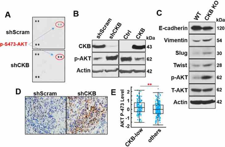 CKB silencing induces AKT-S473 phosphorylation, consistent with their correlation in patient samples. (A) Whole cell lysate from PC3 cells expressing either shScram or shCKB-1 was tested on a human phospho-kinase array (R&D Systems). Red circles show duplicate spots with signals from p-S473-AKT antibody. (B) Immunoblotting for p-S473-AKT, CKB and Beta Actin in DU145 cells expressing shScram or shCKB-1 (left), and PC3 cells carrying empty vector control (EV, Ctrl) or CKB cDNA (right). (C) Immunoblotting for E-Cadherin, Vimentin, Slug, Twist, p-S473-AKT, AKT and beta-Actin in PC3 parental (WT) and CKB knockout cells. (D) Immunohistochemistry analysis of p-S473-AKT in PC3-shScramble and PC3-shCKB xenografts. (E) p-S473-AKT levels in TCGA primary prostate tumors, as analyzed by RPPA (accessed through cBioportal), comparing samples with low CKB mRNA expression (Z-score