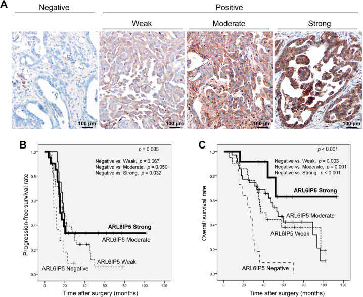 A Representative photomicrographs showing ARL6IP5 immunoreactivity (original magnification, ×20; scale bar, 100 μm). Kaplan–Meier plots for B PFS and C OS in 79 patients with ovarian HGSC.