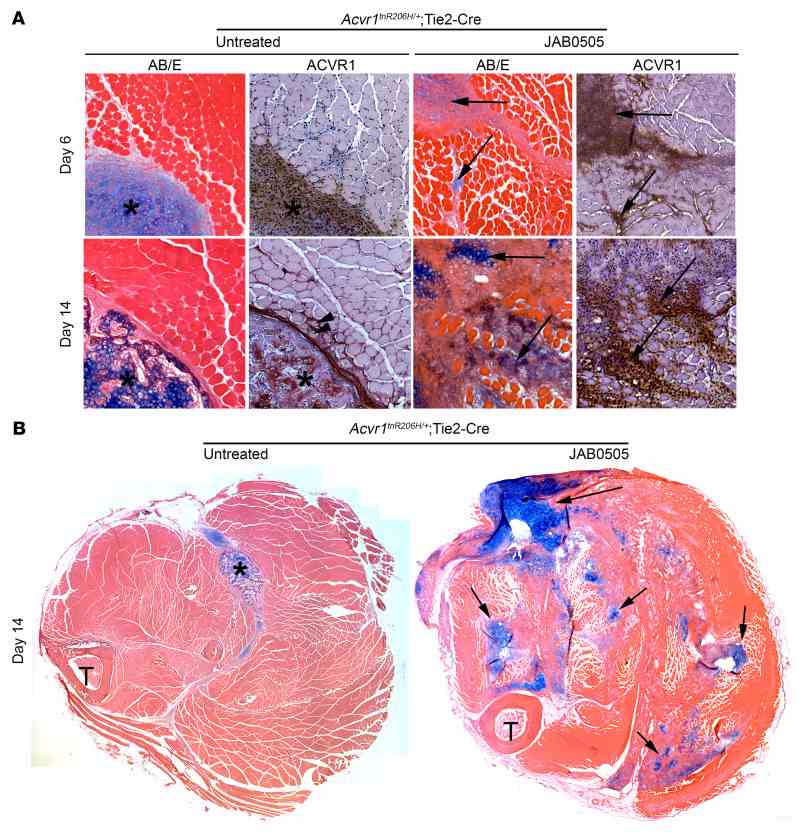 ( A ) Transverse sections of muscle from untreated and JAB0505-treated Acvr1 tnR206H/+ ; Tie2-Cre mice on days 6 and 14 after muscle pinch injury. Alcian blue staining to detect cartilage (blue) and immunohistochemical staining to detect ACVR1 (brown) were performed on nearby sections. Sections processed for Alcian blue were counterstained with eosin, and sections processed for ACVR1 immunohistochemistry were counterstained with hematoxylin. On day 6 after injury, untreated Acvr1 tnR206H/+ ; Tie2-Cre mice exhibited a spatially discrete lesional region (asterisk) that was primarily comprised of ACVR1-positive ectopic cartilage. By day 14, the lesional region (asterisk) of untreated Acvr1 tnR206H/+ ; Tie2-Cre mice displayed sporadic ACVR1 localization and was composed of both cartilage and morphologically apparent bone. In contrast, JAB0505 treated Acvr1 tnR206H/+ ; Tie2-Cre mice displayed multiple apparent cartilaginous lesions and broader distribution of ACVR1 localization on days 6 and 14 (arrows). Centrally located myofiber nuclei (arrowheads), which identify regenerated fibers, were rare in Acvr1 tnR206H/+ ; Tie2-Cre mice, and undetected in JAB0505-treated Acvr1 tnR206H/+ ; Tie2-Cre mice. AB/E, Alcian blue/eosin. Original magnification, ×100. ( B ) Transverse sections of lower hind limbs of Acvr1 tnR206H/+ ; Tie2-Cre mice 14 days after injury. Alcian blue staining revealed numerous cartilaginous lesions (blue, examples at arrows) in injured muscle of JAB0505-treated mice. Sections were counterstained with eosin. T, tibia. Original magnification, ×40.