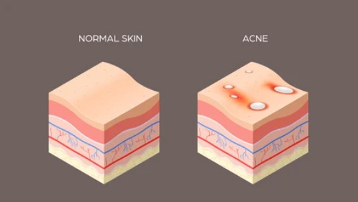 Acne vulgaris Therapeutic Targets - Creative BioMart