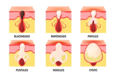 Acne vulgaris Therapeutic Targets - Creative BioMart