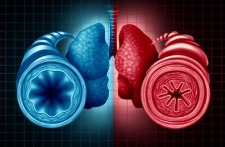 Asthma Therapeutic Targets - Creative BioMart