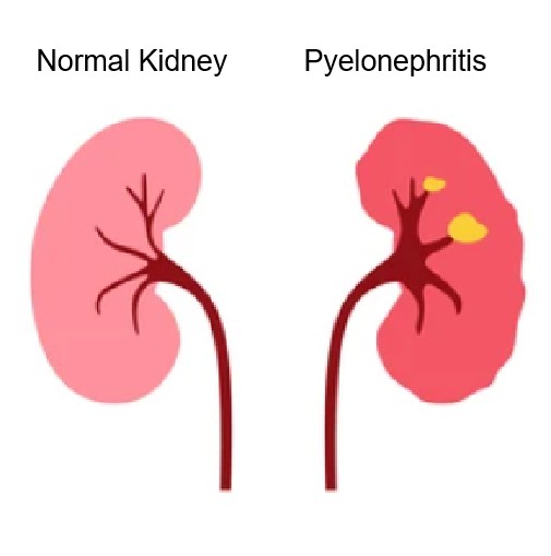 Glomerulonephritis - Creative BioMart 