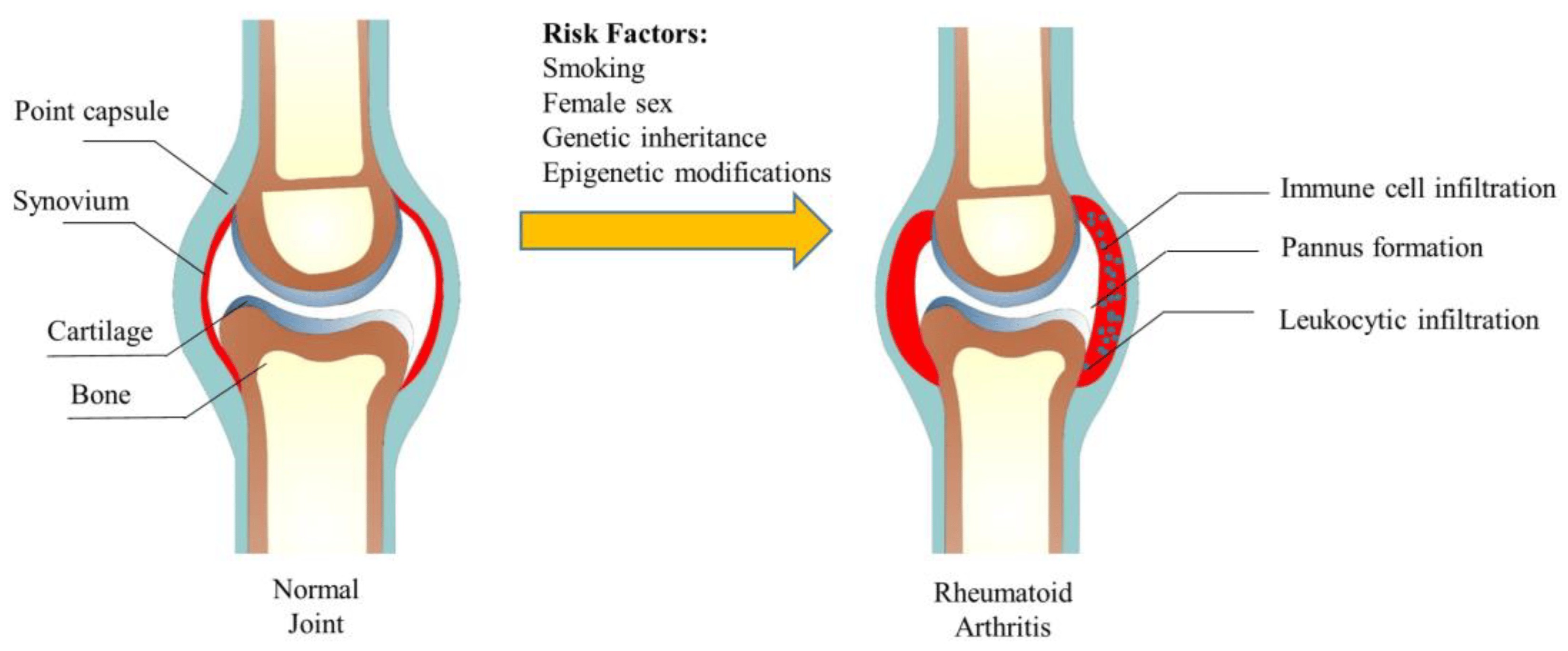 The structure of the joint and its change in rheumatoid arthritis. 