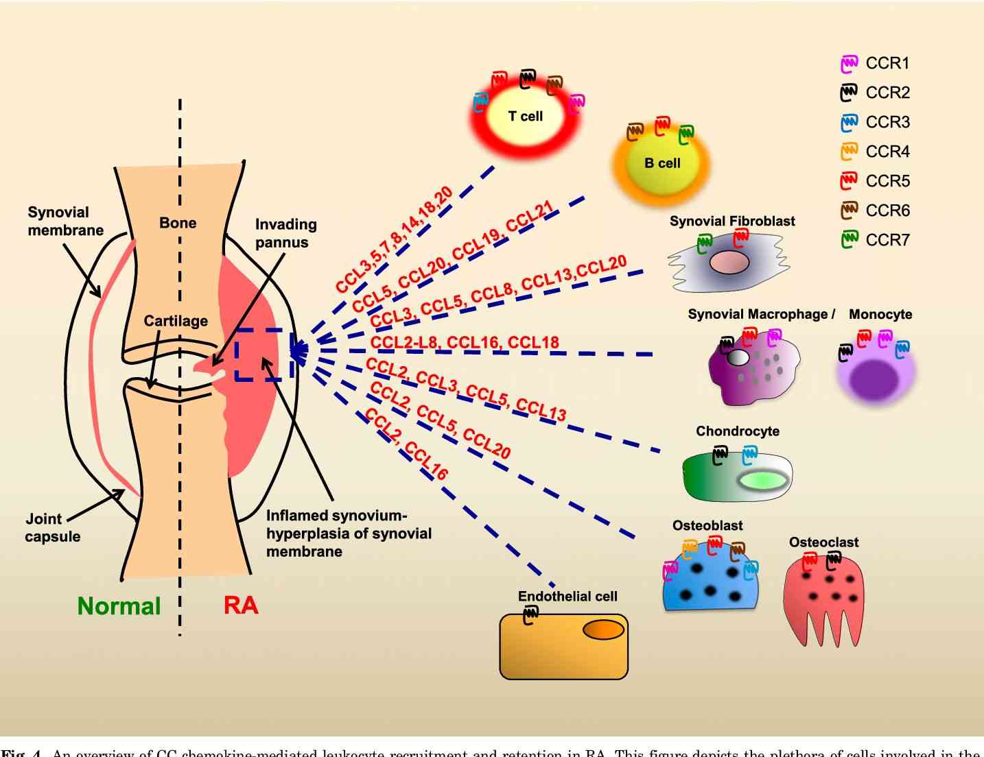 An overview of CC chemokine-mediated leukocyte recruitment and retention in RA.
