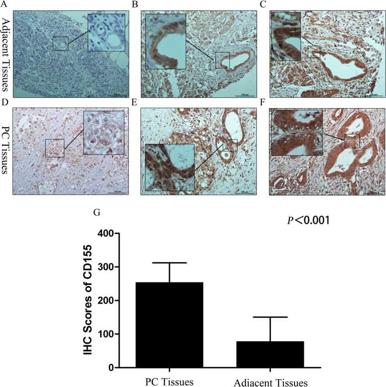 CD155 (PVR) expression in pancreatic cancer and adjacent tissues.