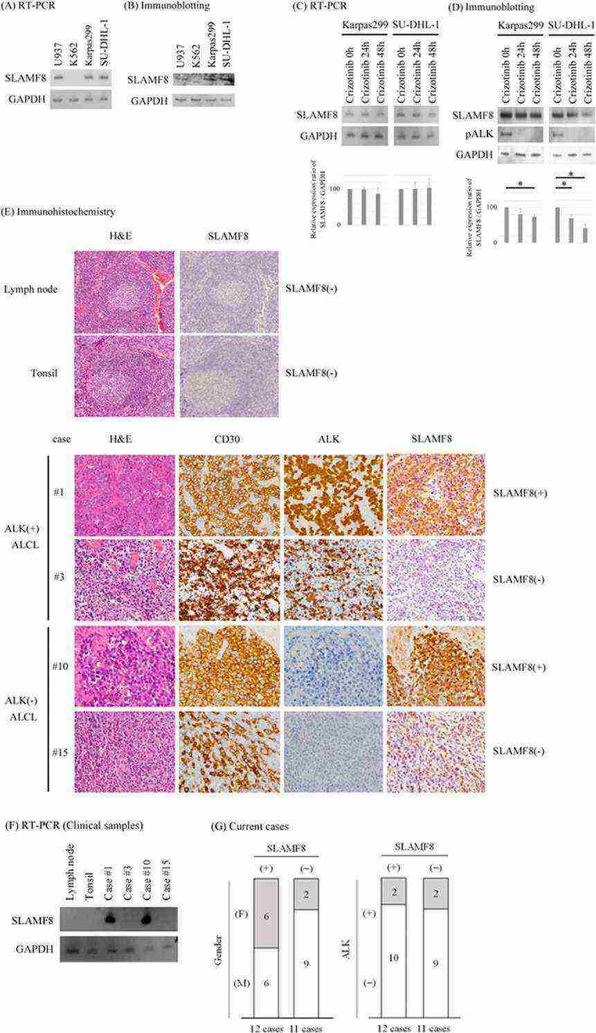 SLAMF8 is expressed in human ALCL cell lines Karpas299 and SU-DHL-1 and in human ALCL pathological samples.