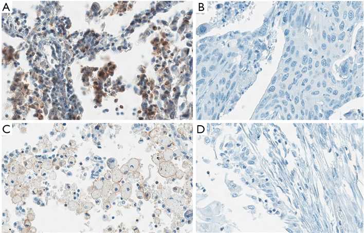 Expression of TIM-3 on tumor cells and TILs.