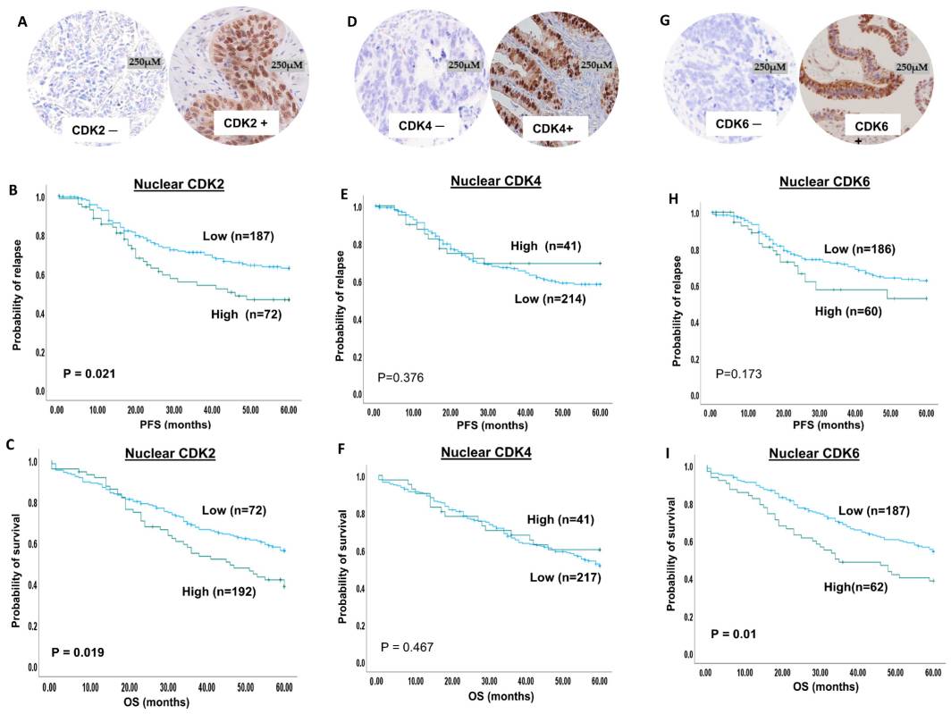 CDK2, 4 and 6 immunohistochemical expression in ovarian cancers.