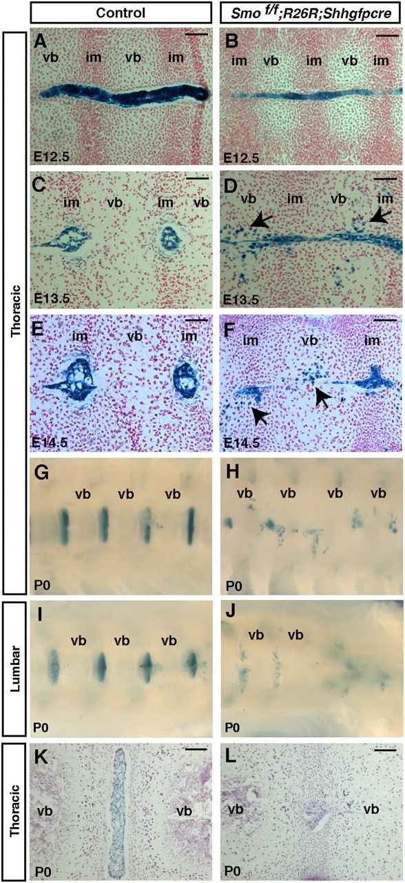 Aberrant migration of notochord cells throughout the vertebral column upon removal of hedgehog signaling in the notochord.